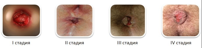 Стадии геморроя