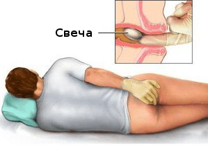 Свечи (суппозитории) от геморроя