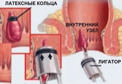 Легирование геморроя