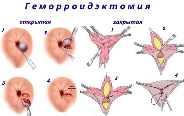 Геморроидэктомия