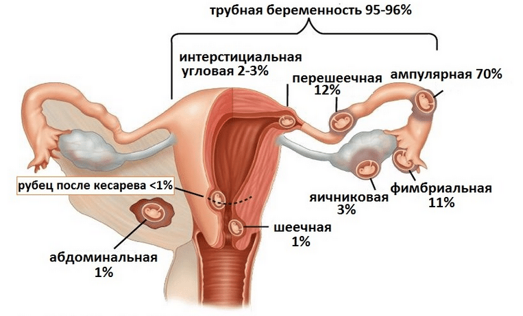 Что такое внематочная беременность