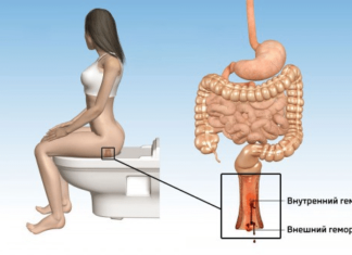 Лікування геморою в домашніх умовах. Як лікувати геморой