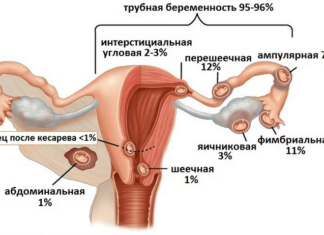 Симптоми і ознаки позаматкової вагітності на ранніх термінах і пізніх