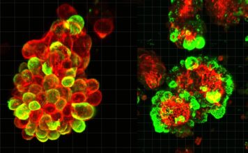 Смертельна таємниця раку яєчників: як ракові клітини залучають союзників для швидкого поширення