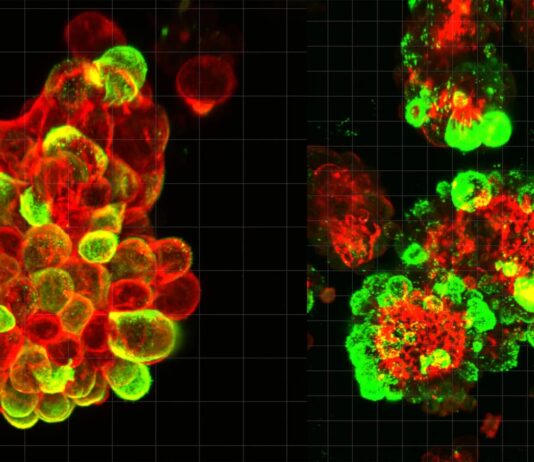 Смертельна таємниця раку яєчників: як ракові клітини залучають союзників для швидкого поширення